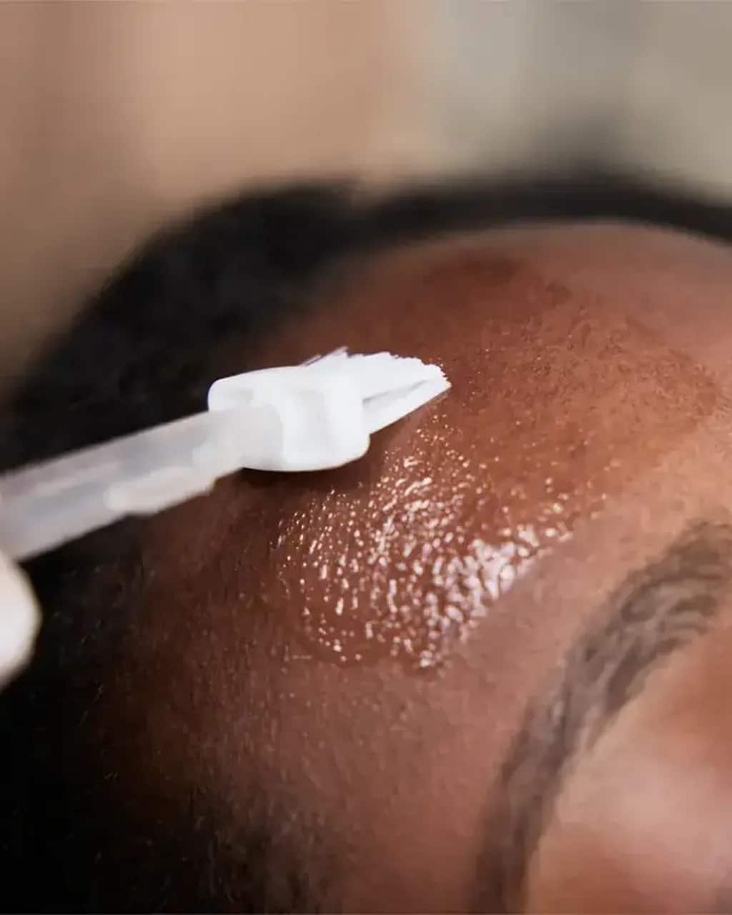A professional skin peel being applied to a forehead with a brush