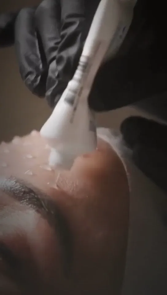A needling head being passed over the skin during a treatment