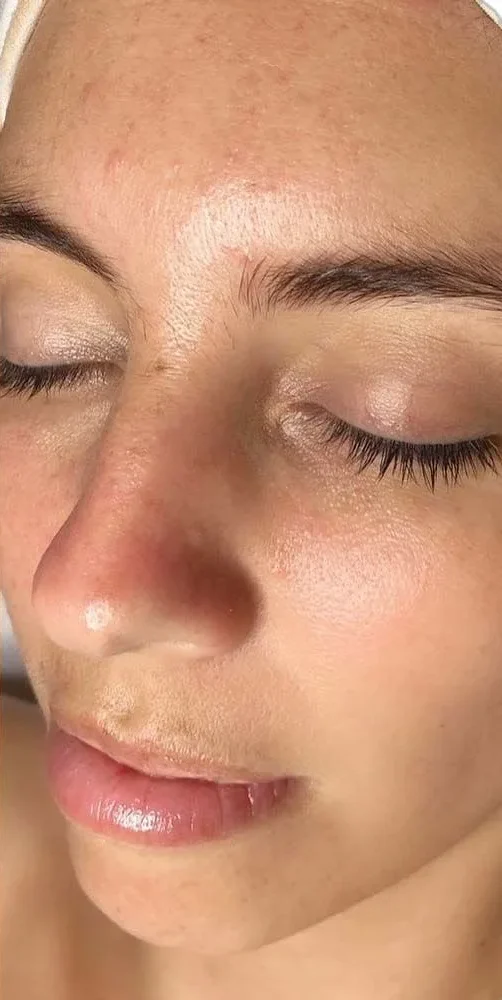 Same face after skin needling, more even tone