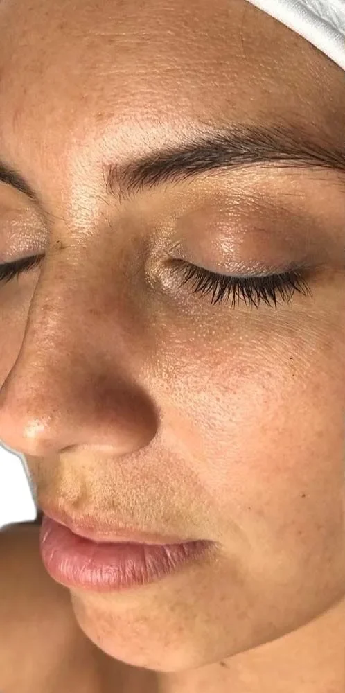 Face with dull, uneven tone, eyes closed, before skin needling
