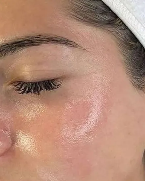 Same cheek straight after one facial and peel