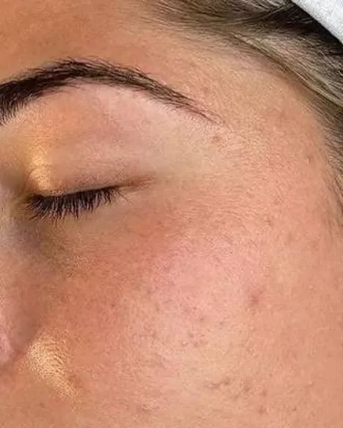 Cheek with dull, congested-looking skin before the facial and peel