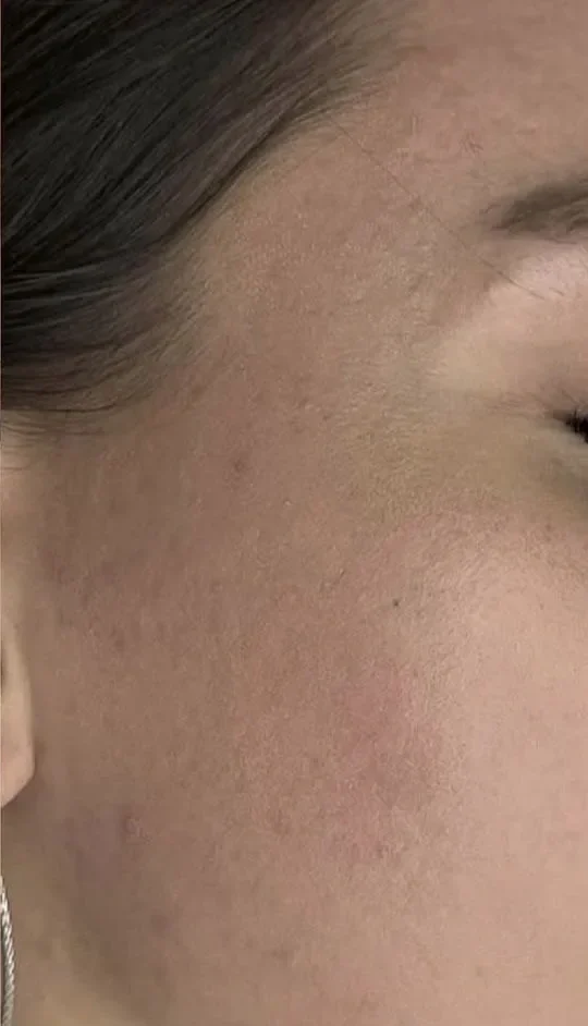 Same cheek after skin needling