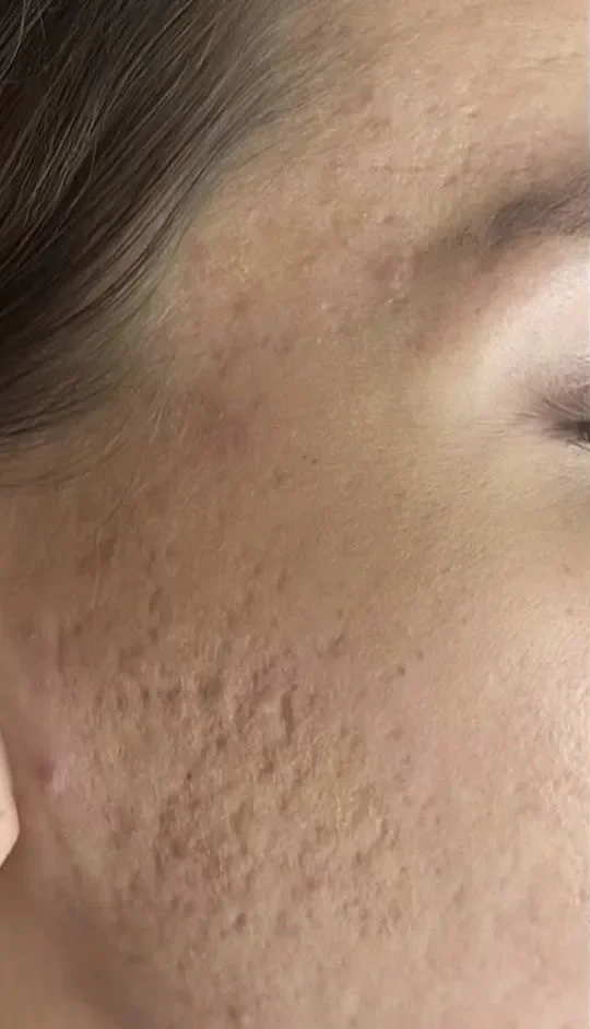 Cheek with pitted acne scarring, side view, before skin needling