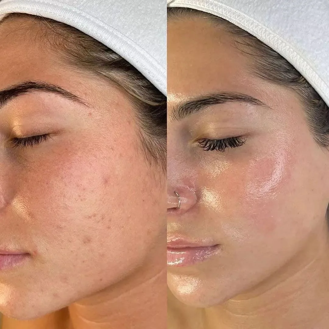 Before and after laser and light treatment for pigmentation and congestion