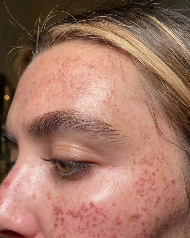 Pigment darkening and peppering in the days after an IPL session