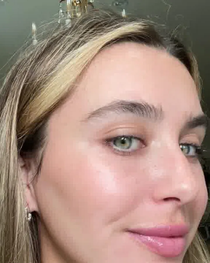 Clearer, even-toned skin at the end of an IPL course