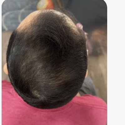 Hair regrowth after treatment - Daniel