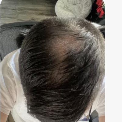 Hair regrowth after treatment - Ryan