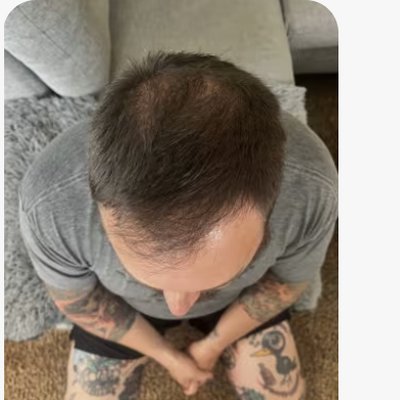 Hair regrowth after treatment - Steve
