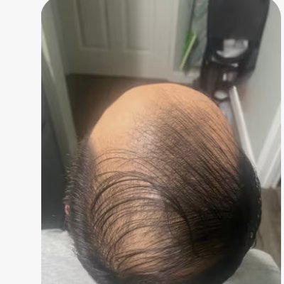 Hair loss before treatment - Daniel