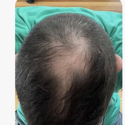 Hair loss before treatment - Ryan