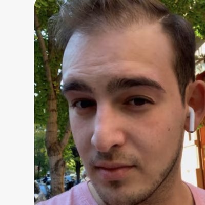 Hair loss before treatment - Matt