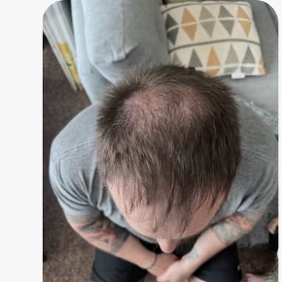 Hair loss before treatment - Steve